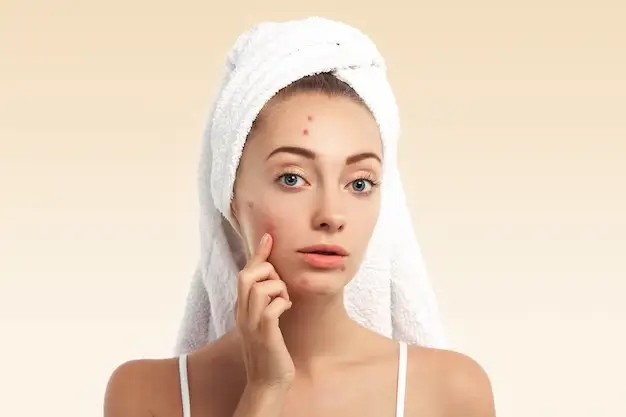 Anti Acne Facial at The Icon Studio